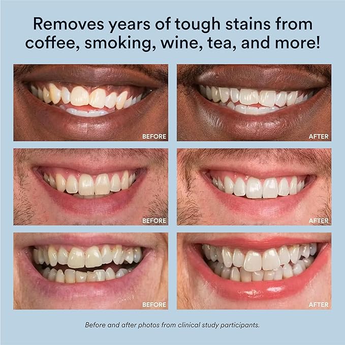 Auraglow Teeth Whitening Kit, LED Accelerator Light, 35% Carbamide Peroxide Teeth Whitening Gel, 20+ Whitening Treatments, Whitens up to 10 Shades in 7 Days